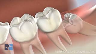 Wisdom Teeth Removal at Round Rock Oral Surgery [upl. by Christy]