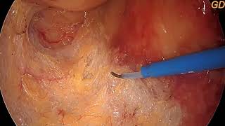 SPHINCTER PRESERVATION SURGERIES FOR RECTAL CANCER [upl. by Nnoryt]