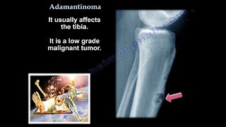 Adamantinoma  Everything You Need To Know  Dr Nabil Ebraheim [upl. by Annoved]