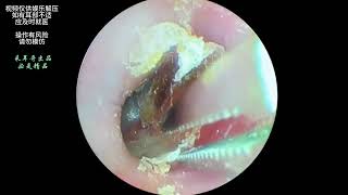 Processing fungal thick dry patches on the eardrum [upl. by Eitirahc104]