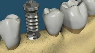 Exodontia  distalização ortodôntica para instalação de implante [upl. by Naahsar]