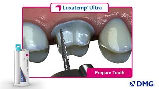 Luxatemp Ultra Rated 1 in Flexural Strength [upl. by Namijneb]