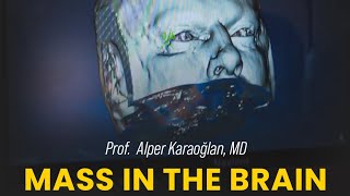 Mass In The Brain  Prof Alper Karaoğlan MD [upl. by Dahle]