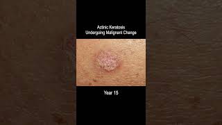 Skin Cancer Development Time Lapse Normal to Squamous Cell Carcinoma Over 25 Years [upl. by Bianka]