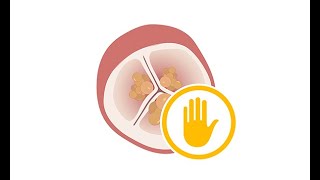 Prophylactic antibiotic treatment to prevent infective endocarditis [upl. by Roxanne]