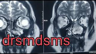 nasal mass polyp drsmdsms [upl. by Taimi101]