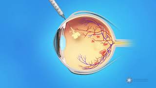 Eye Injections for Central Retinal Vein Occlusion CRVO [upl. by Ellehcrad]