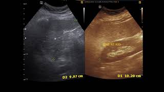 Ultrasound cases 361 of 2000  Utricle Cyst Splenic Cyst Hypoechoic nodule Breast Duct ectasia [upl. by Dyob]