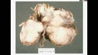 HistopathologyBrain Meningioma [upl. by Jonati]