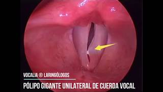 PÓLIPO GIGANTE DE CUERDAS VOCALES  GYANT VOCAL FOLD POLYP [upl. by Merwin]