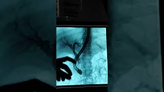 ERCP procedure Liver Biliary system  Radiology  Gastroenterology [upl. by Arlan]