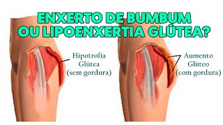 ENXERTO NO BUMBUM OU LIPOENXERTIA DE GLÚTEO [upl. by Nnyleahs529]