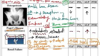 USMLE ACE Video 185 Key Metabolic Bone Disorders Classification Signs and Associated Conditions [upl. by Trumann]