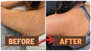 HOW I GOT RID OF MY STRETCH MARKS  NUE CONCEAL NUE CLEAR [upl. by Severen849]