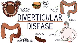 Understanding Diverticulosis and Diverticulitis [upl. by Elyrehc]