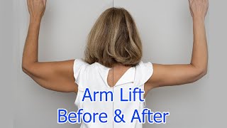 Arm Lift 14 Weeks Post Op FAQs  Brachioplasty Surgery Journey Part 3 [upl. by Khalil]