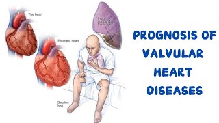 PROGNOSIS OF VALVULAR HEART DISEASES 📈📉 [upl. by Atterys]