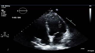 TTE  Acute OM infarct [upl. by Winston]