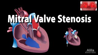 Mitral Valve Stenosis Animation [upl. by Nyliahs]