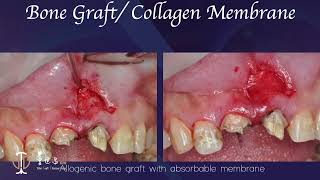 Restorative Crown Lengthening in Esthetic Zone amp Apicoectomy with Giuded Tissue Regeneration V [upl. by Roach]