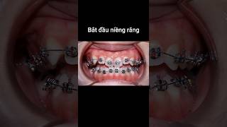 Niềng răng cắn ngược  underbite braces braces orthodontist dental [upl. by Heringer44]