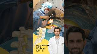 Treatment of Osteoporotic spine fracture  Dr Dheeraj Batheja  Artemis Hospital doctor spine [upl. by Leryt]