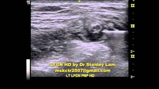 Ultrasound Guided Lateral Femoral Cutaneous Nerve LFCN Hydrodissection [upl. by Nelaf]