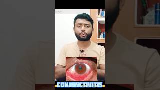 Conjunctivitis  কনজাংটিভাইটিস conjunctivitis conjunctivitistreatment allergicconjunctivitis [upl. by Winifield44]