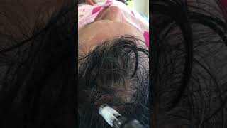 Tratamiento para la calvicie  Alopecia Cali Colombia  Parte 1 [upl. by Nirok]