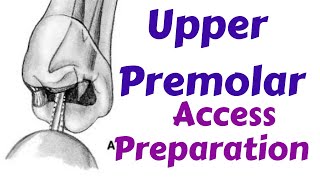 Upper Maxillary Premolars  Endodontic Access cavity Preparation Endodontic Lecture amp Tutorial [upl. by Jeanie]