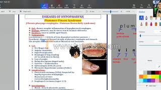 ENT  Plummer vinson amp pharyngeal pouch [upl. by Hester]