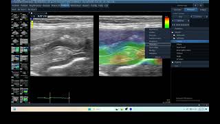 IQ 284 PANCREATIC ELASTOGRAPHY GI BLEEDING ULTRASOUND ECHOPAC ANALYSIS [upl. by Aleece648]