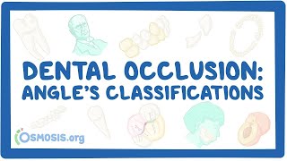 Dental occlusion  Angle’s classifications [upl. by Poll]