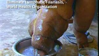 Elephantiasis Afflicts 120 Million in Africa Asia [upl. by Anitnerolf]