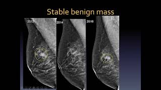 Mammography interpretation [upl. by Oneladgam]