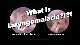 Laryngomalacia  What is it what are the symptoms how is it managed [upl. by Jane408]