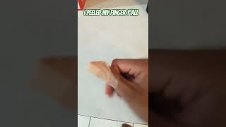 I Peeled My Thumb with a YPeeler 😱 Watch This [upl. by Eniamrehs]