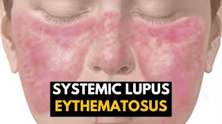 Systemic Lupus Eythematosus SLE Causes Signs and Symptoms Diagnosis and Treatment [upl. by Hake]