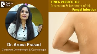 White Patches on Skin Is it TINEA VERSICOLOR  Is it Fungal  DrAruna Prasad  Doctors Circle [upl. by Compte]