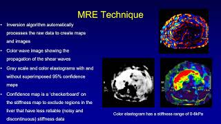 MR Elastography MRE of Liver Technique Interpretation and Applications Dr Naveen Kalra [upl. by Eened]