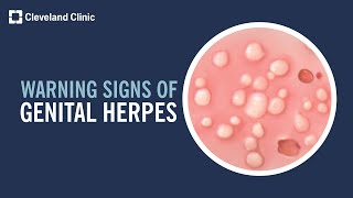 5 Warning Signs of Genital Herpes [upl. by Janie437]