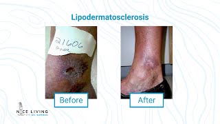 Vein Disease for Primary Care Physicians Part 2  swelling lipodermatosclerosis amp venous dermatitis [upl. by Sema]