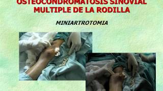 Dr David González Aceves OSTEOCONDROMATOSIS DE RODILLA wmv [upl. by Leede]