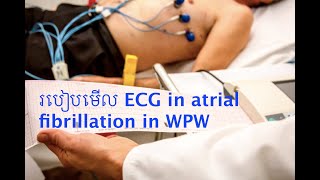 ECG Atrial fibrillation in WPW [upl. by Assirim]