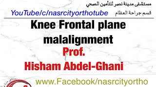 Knee frontal malalignmentProfHisham Abdelghani Nasrcity online lectures 2020 [upl. by Jens]