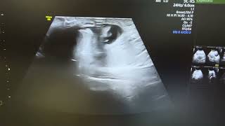 Ultrasound of strangulated umbilical hernia showing omental herniation with fluid [upl. by Neraa]