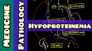 Hypoproteinemia  causes and diagnosis  Pathology Medicine [upl. by Feenah302]