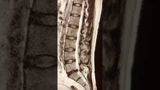 L5S1 Disc herniation radiology shortsviral shortvideo short medical [upl. by Loftus]