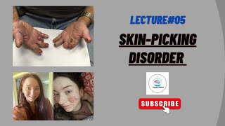 what is excoriation disorder  Dermatillomania Skin picking disorder in Urdu by Areej Awan [upl. by Filippo545]