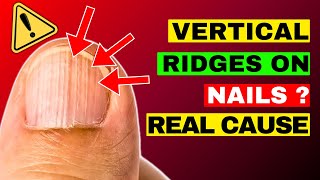 The REAL Causes of VERTICAL RIDGES On Your Nails [upl. by Ardnic]